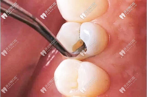 小黑點發(fā)展到中齲就需要補牙治療了