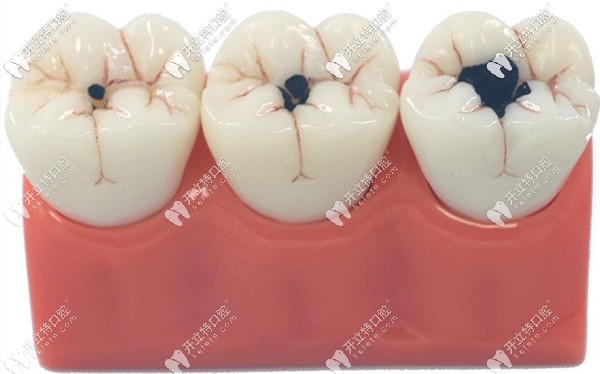 牙齒上面有小黑點怎么辦