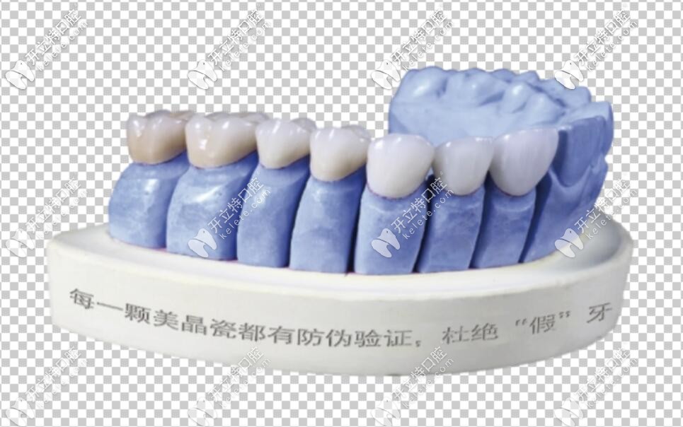 滬鴿美晶瓷全瓷牙模型