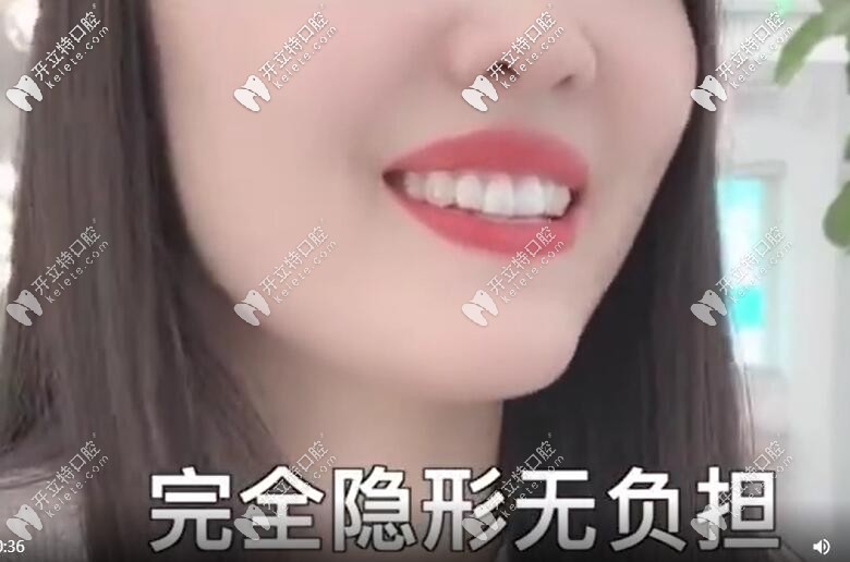 佩戴隱適美牙套的圖片