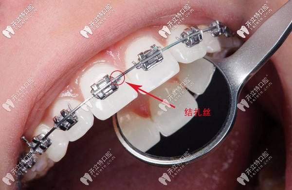 金屬托槽矯正器