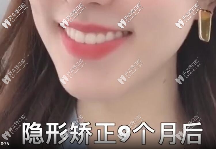 門牙不齊帶隱形牙套矯正9個月效果圖
