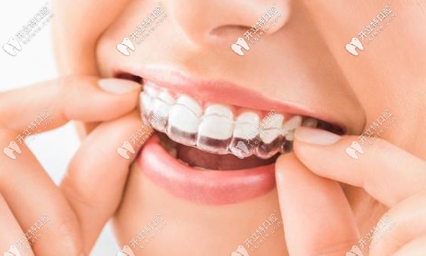 求鄭州口腔矯正牙齒的費(fèi)用，隱適美箍牙價格一般多少錢