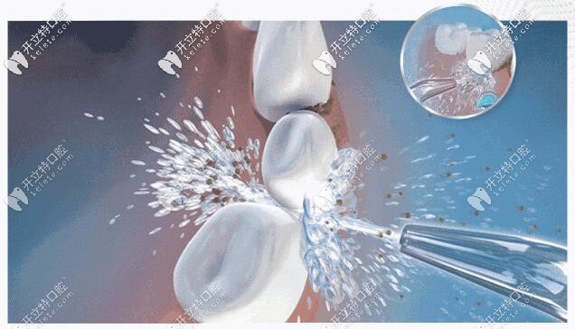 超聲波洗牙：有效清潔牙齒、保護(hù)牙齒健康