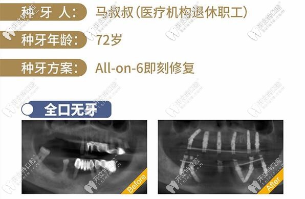 南寧柏樂(lè)口腔醫(yī)院種植牙技術(shù)咋樣?醫(yī)生列表的彭布強(qiáng)可靠嗎