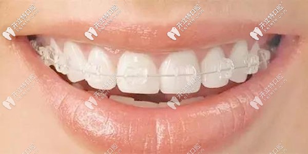 陶瓷托槽半隱形矯正