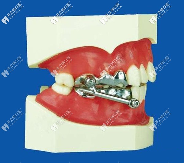 herbest矯正下頜后縮價格貴嗎?談談原理及術后改變成效