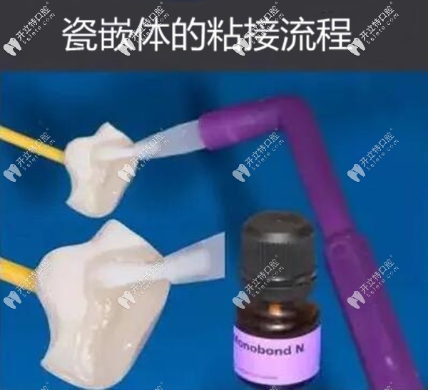 牙齒做全瓷嵌體的粘接步驟和流程