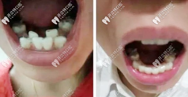 在朔州做隱形牙齒矯正的案例圖