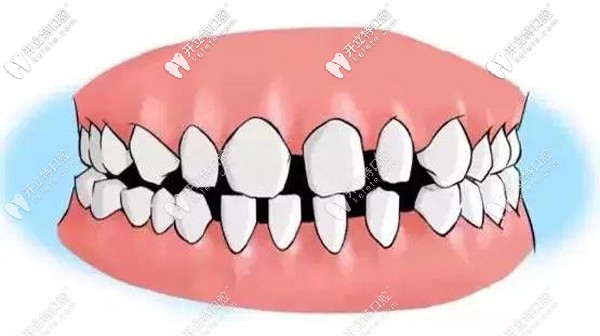 30歲牙齒稀疏門牙縫大怎么辦，做牙齒貼面or帶牙套矯正好