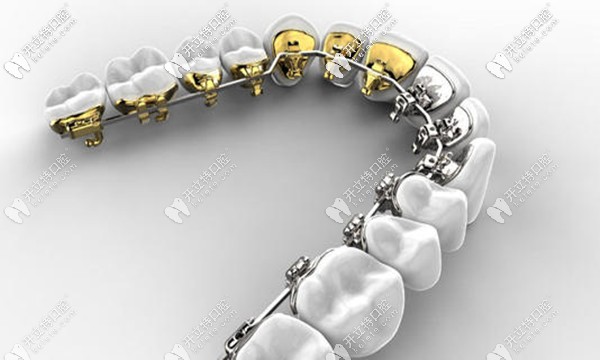 岳陽(yáng)市舌側(cè)矯正收費(fèi)