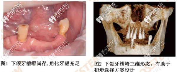 下頜無牙者利用奧齒泰轉(zhuǎn)換基臺完成了數(shù)字化導板即刻修復