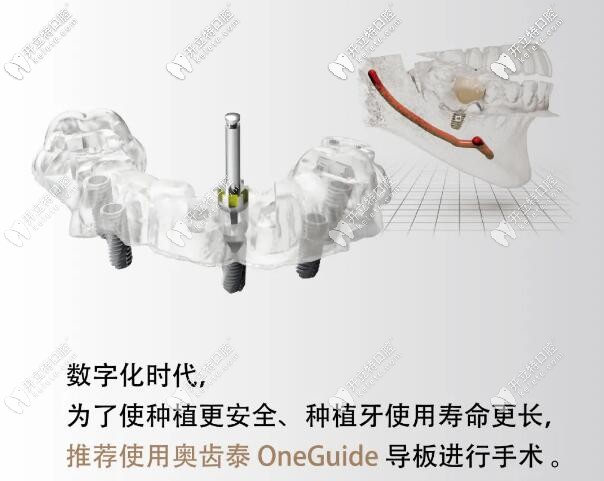 韓國(guó)奧齒泰3D數(shù)字化種植牙導(dǎo)板
