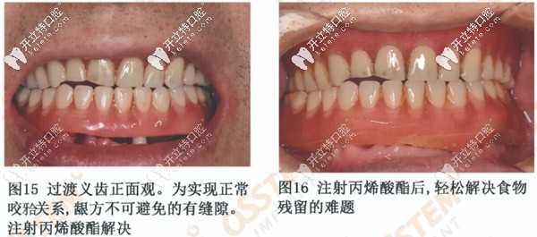 過渡義齒正面圖