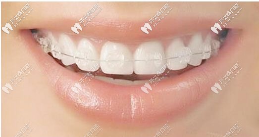 陶瓷冰晶半隱形矯正器