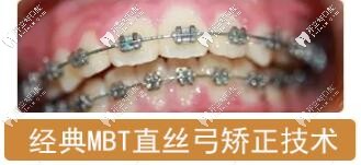 直絲弓矯治技術