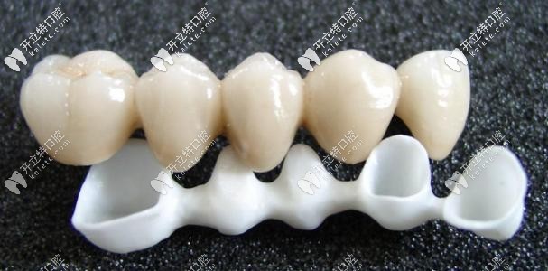 杜塞拉姆全瓷牙怎么樣?這款德國(guó)氧化鋯全瓷牙價(jià)格/優(yōu)點(diǎn)在這