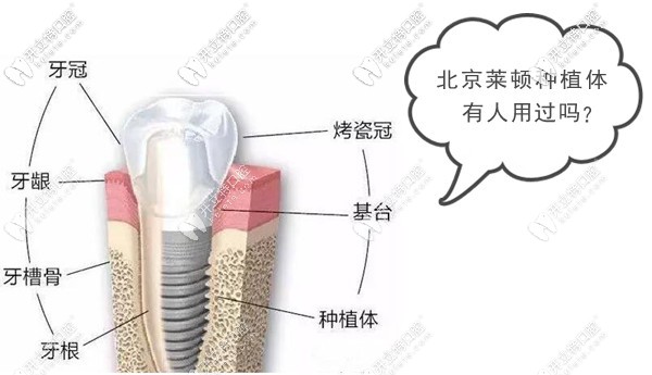 北京萊頓種植體有人用過嗎?聽說這是國產(chǎn)種植牙主流品牌