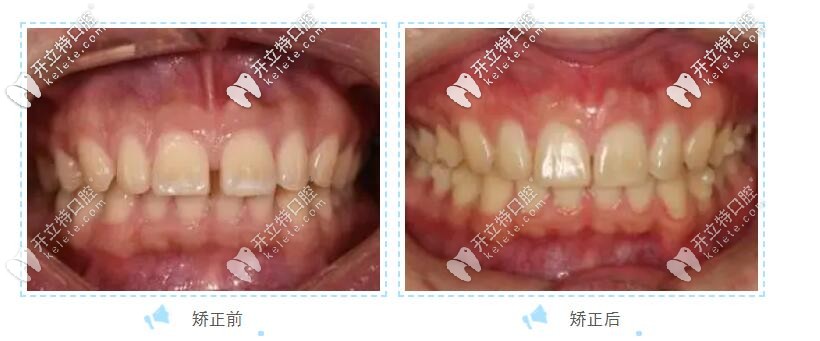 前牙深覆合矯正前后變化圖