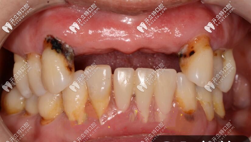上半口多顆門牙掉光的照片