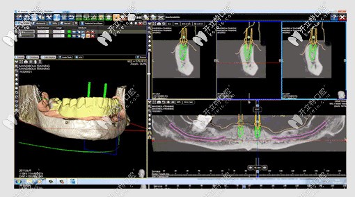 德韓口腔在電腦上看種牙模擬效果