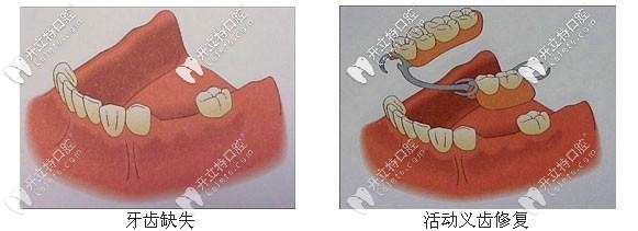 活動義齒修復后圖示