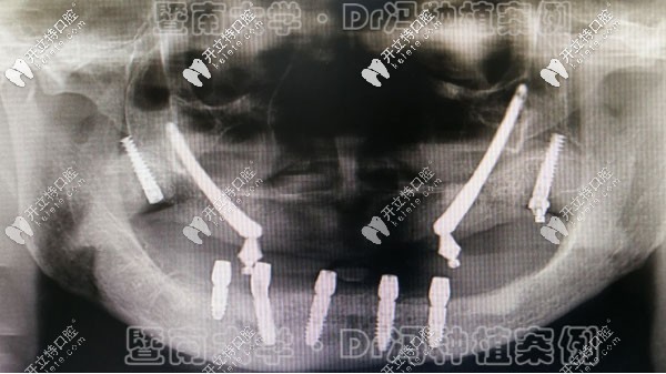 廣州暨大穗華馮智強博士又成功完成1例穿顴穿翼種植牙案例