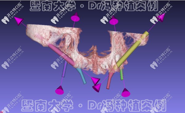 穿顴骨種植技術(shù)的電腦模擬效果 穿顴骨種植技術(shù)的電腦模擬效果