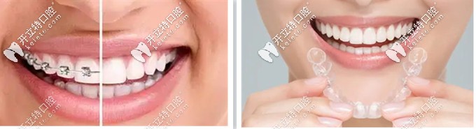 臨沂牙科醫(yī)院常見的：金屬矯正器與隱形牙齒矯正器