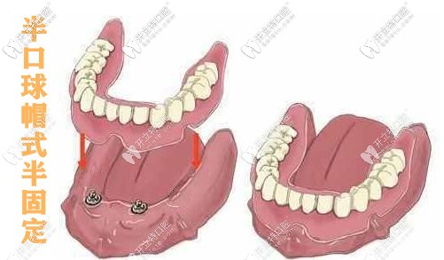 長沙好大夫：半口球帽式半固定種植牙