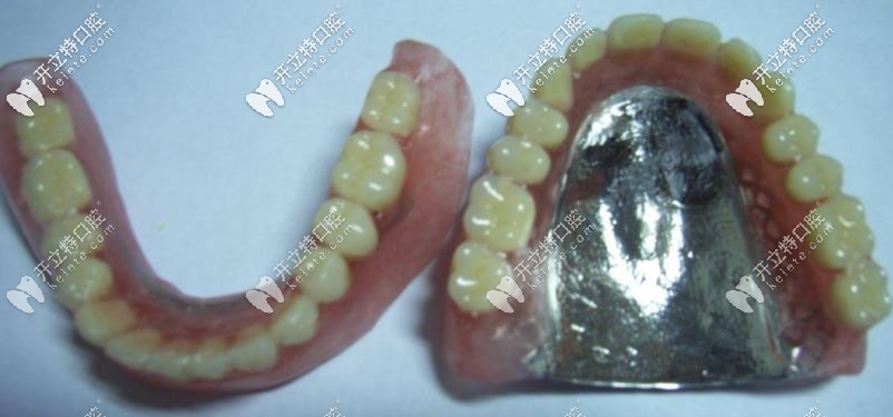 活動義齒的正面示意圖