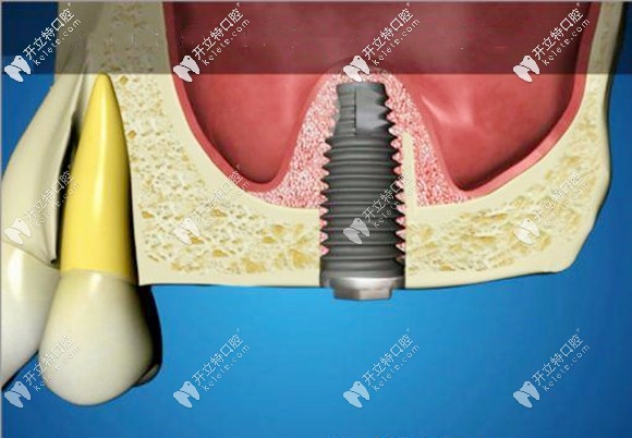 上頜竇內(nèi)提升術(shù)參考價格