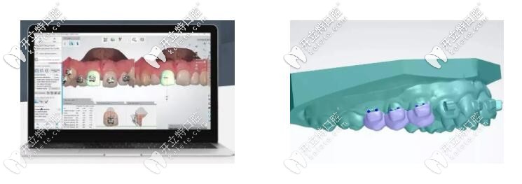 藍天口腔的智能正畸粘接導板技術