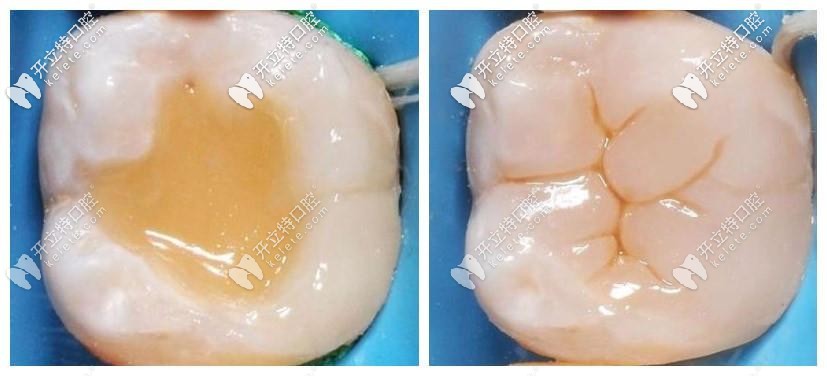 補牙材質(zhì)與真牙無差