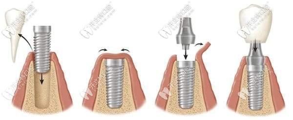 ibs種植體的優(yōu)勢有哪些