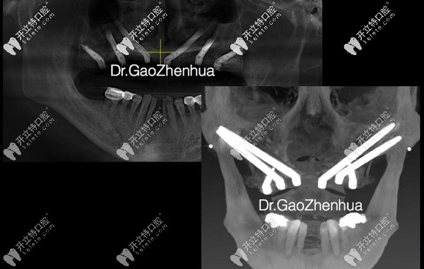 極端缺骨條件下的穿顴穿翼即刻負(fù)重