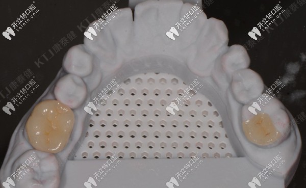 打印模型及康泰健嵌體制作