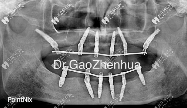 滿口即刻負(fù)重種植技術(shù)