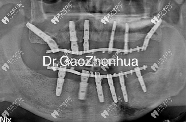 上頜VIIV、下頜6顆即刻種植方案
