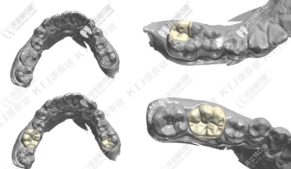 康泰健瓷嵌體數(shù)字化設(shè)計(jì)