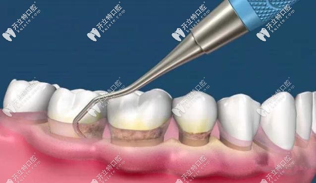 齦下刮治示意圖