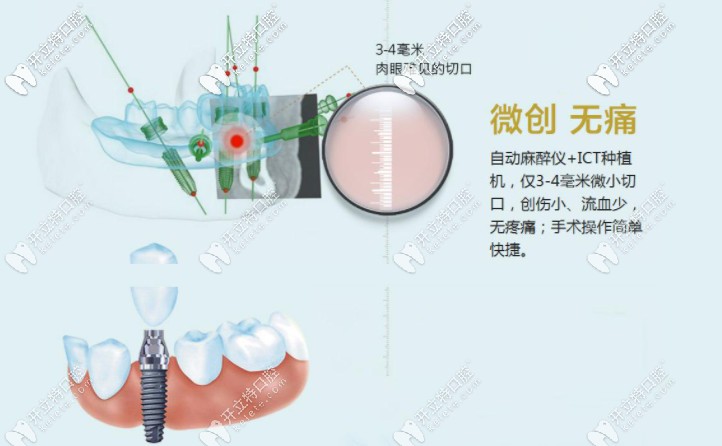微創(chuàng)即刻種植牙技術(shù)