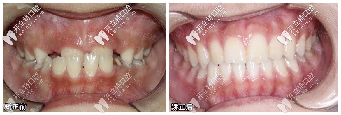 在優(yōu)麗仕口腔矯正前后對比圖