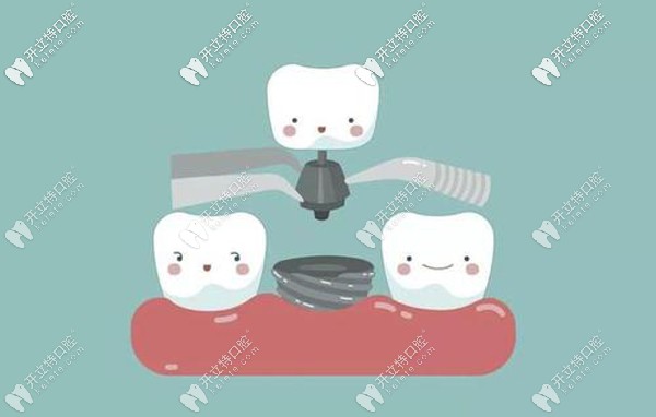 中諾口腔種植牙時(shí)間快