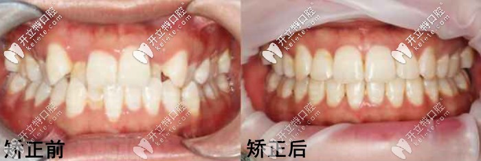沈陽億美佳口腔的矯正案例