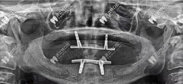 陳叔叔口腔檢查情況