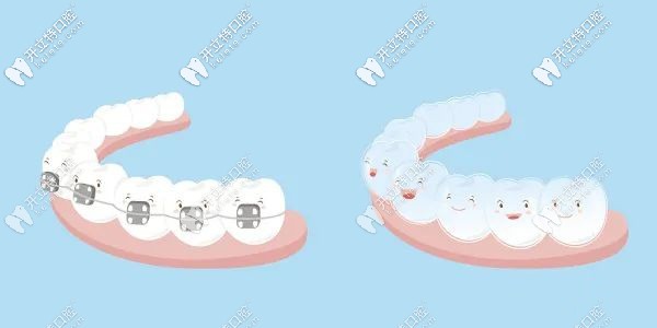  門牙不齊想拔了做種植牙?來(lái)聽牙醫(yī)說(shuō)說(shuō)門牙長(zhǎng)歪的矯正方法
