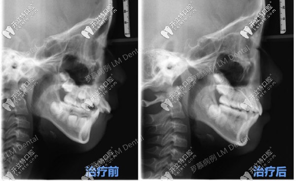CT可以明顯看到羅慕干預(yù)后的效果