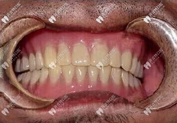 70歲無(wú)牙老人做全口種植牙真實(shí)感受：立得用種植牙技術(shù)靠譜