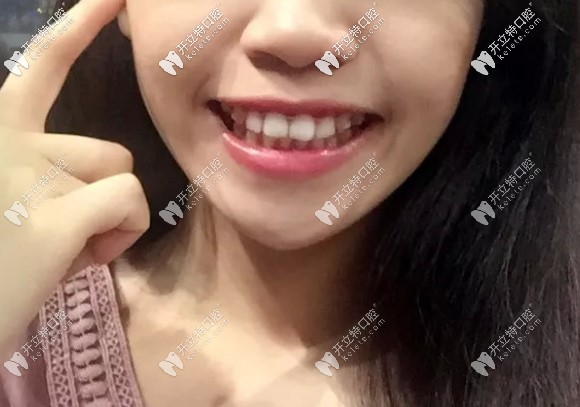 骨性凸嘴戴38幅牙套的正臉照